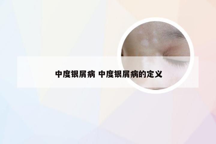 中度银屑病 中度银屑病的定义