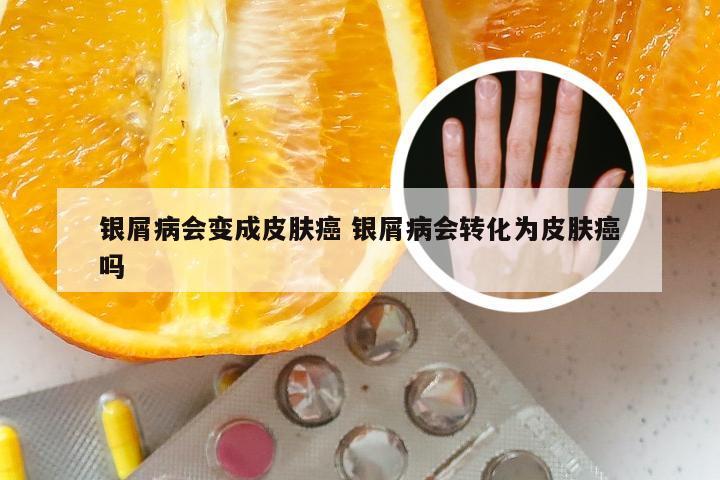 银屑病会变成皮肤癌 银屑病会转化为皮肤癌吗