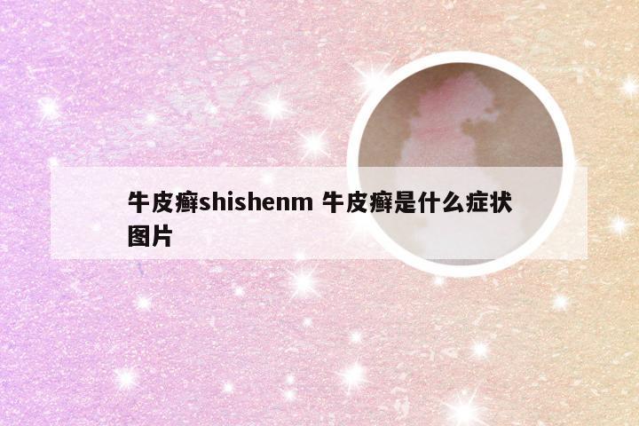 牛皮癣shishenm 牛皮癣是什么症状图片