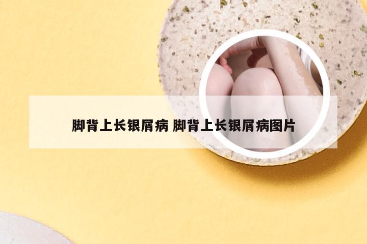 脚背上长银屑病 脚背上长银屑病图片