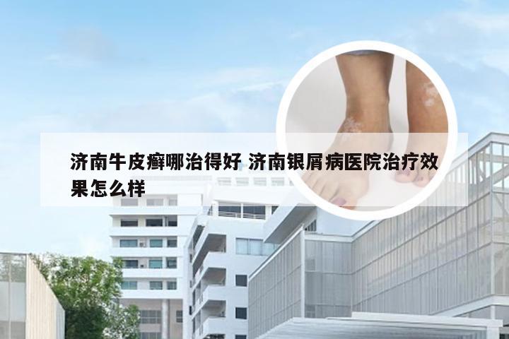 济南牛皮癣哪治得好 济南银屑病医院治疗效果怎么样