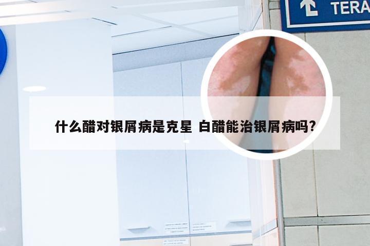 什么醋对银屑病是克星 白醋能治银屑病吗?