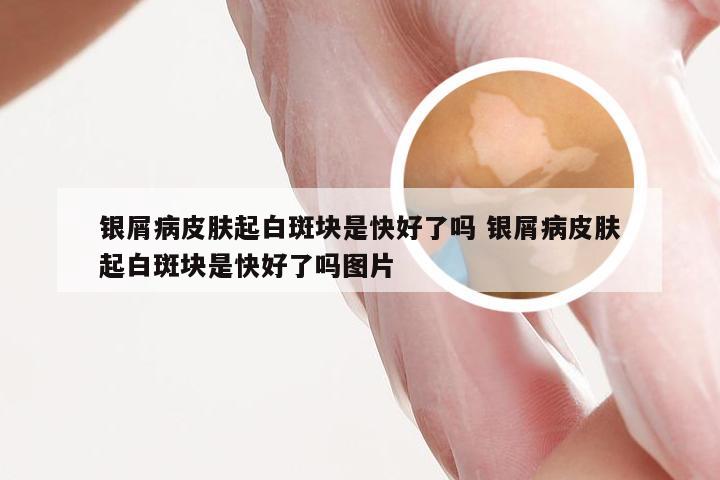 银屑病皮肤起白斑块是快好了吗 银屑病皮肤起白斑块是快好了吗图片