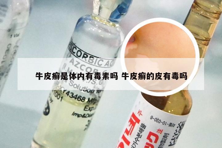牛皮癣是体内有毒素吗 牛皮癣的皮有毒吗