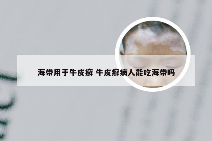 海带用于牛皮癣 牛皮癣病人能吃海带吗
