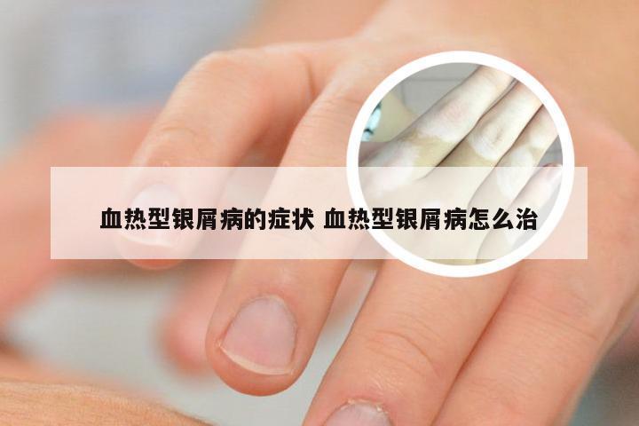 血热型银屑病的症状 血热型银屑病怎么治