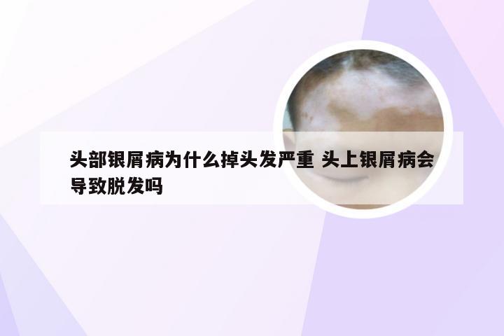 头部银屑病为什么掉头发严重 头上银屑病会导致脱发吗