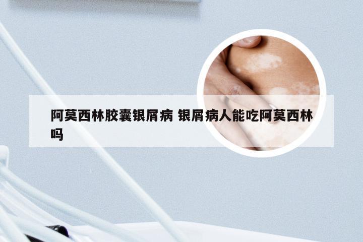 阿莫西林胶囊银屑病 银屑病人能吃阿莫西林吗
