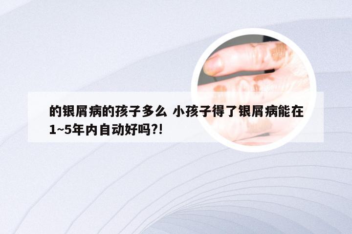 的银屑病的孩子多么 小孩子得了银屑病能在1~5年内自动好吗?!