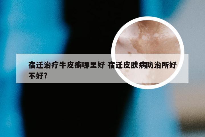 宿迁治疗牛皮癣哪里好 宿迁皮肤病防治所好不好?