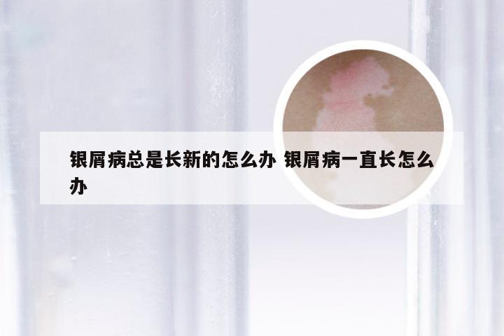 银屑病总是长新的怎么办 银屑病一直长怎么办