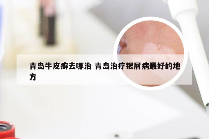 青岛牛皮癣去哪治 青岛治疗银屑病最好的地方
