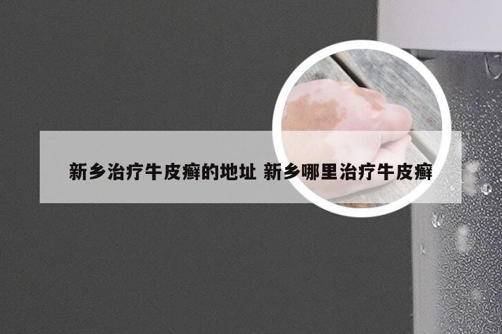 新乡治疗牛皮癣的地址 新乡哪里治疗牛皮癣