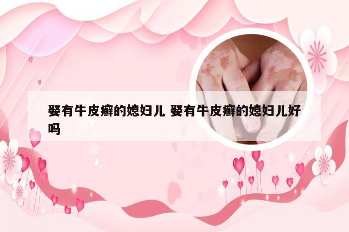 娶有牛皮癣的媳妇儿 娶有牛皮癣的媳妇儿好吗
