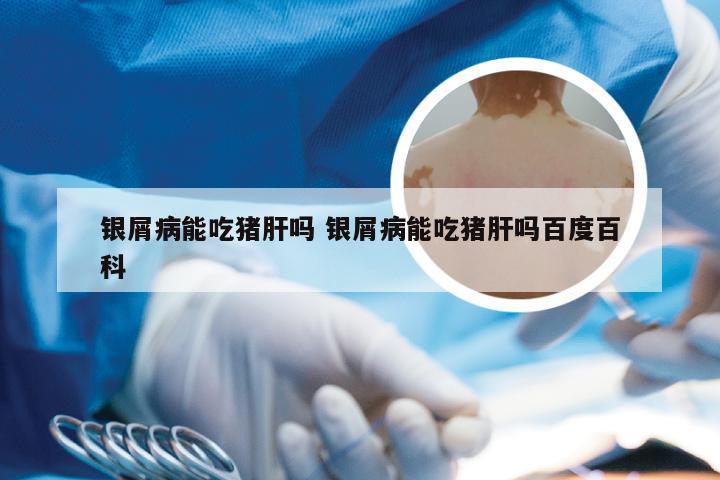银屑病能吃猪肝吗 银屑病能吃猪肝吗百度百科
