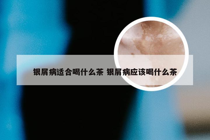 银屑病适合喝什么茶 银屑病应该喝什么茶