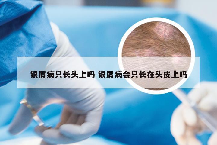 银屑病只长头上吗 银屑病会只长在头皮上吗