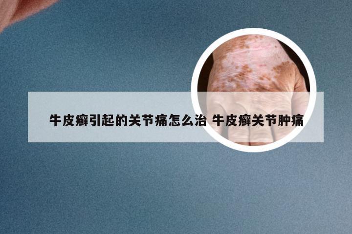 牛皮癣引起的关节痛怎么治 牛皮癣关节肿痛