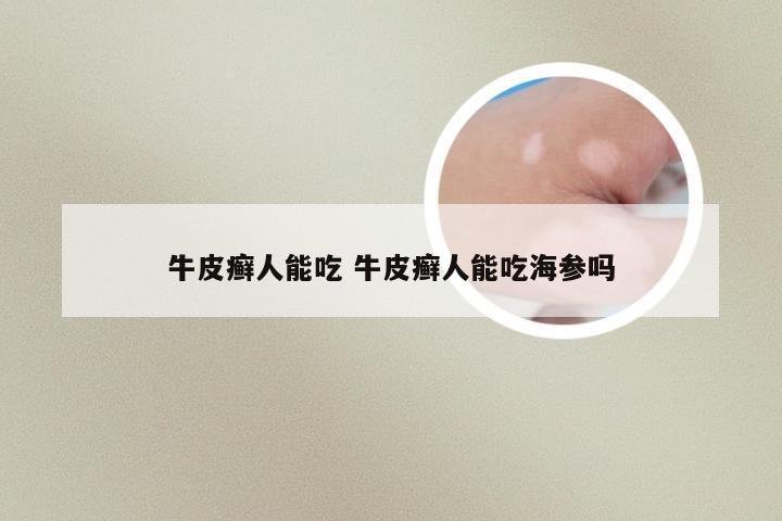 牛皮癣人能吃 牛皮癣人能吃海参吗