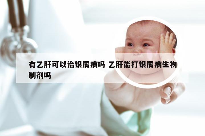 有乙肝可以治银屑病吗 乙肝能打银屑病生物制剂吗