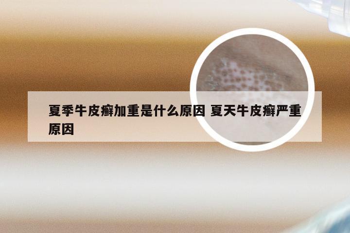 夏季牛皮癣加重是什么原因 夏天牛皮癣严重原因