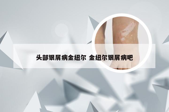 头部银屑病金纽尔 金纽尔银屑病吧