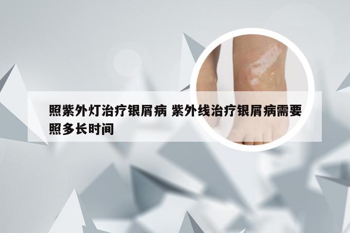 照紫外灯治疗银屑病 紫外线治疗银屑病需要照多长时间