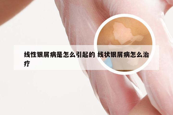 线性银屑病是怎么引起的 线状银屑病怎么治疗