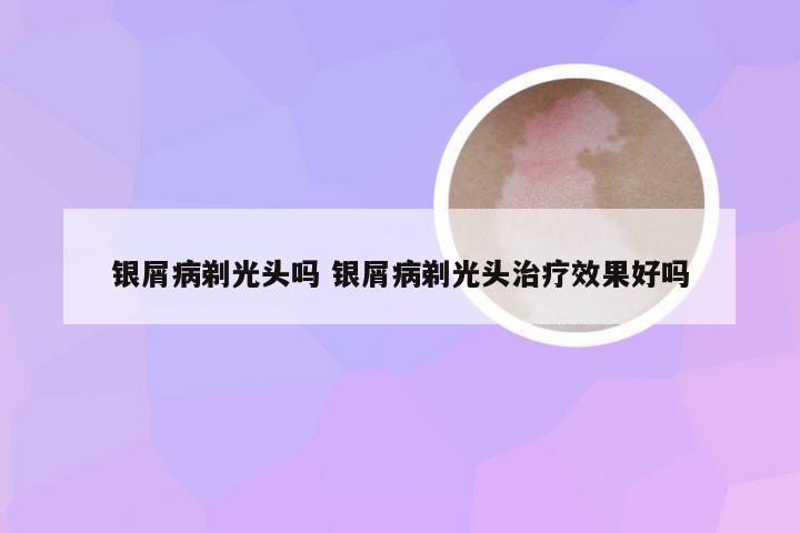 银屑病剃光头吗 银屑病剃光头治疗效果好吗