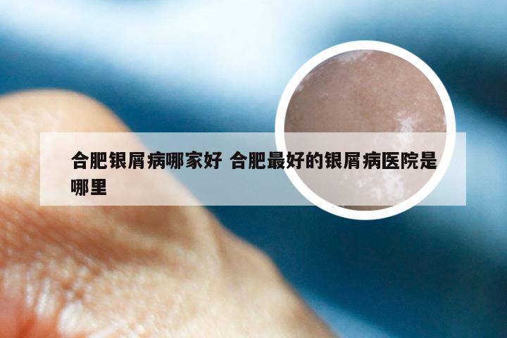 合肥银屑病哪家好 合肥最好的银屑病医院是哪里