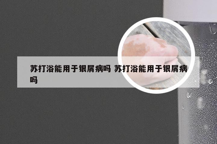 苏打浴能用于银屑病吗 苏打浴能用于银屑病吗