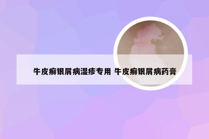 牛皮癣银屑病湿疹专用 牛皮癣银屑病药膏