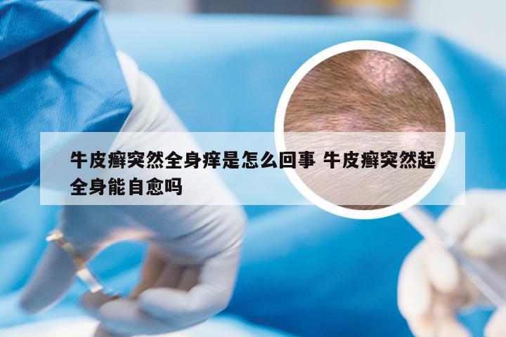 牛皮癣突然全身痒是怎么回事 牛皮癣突然起全身能自愈吗