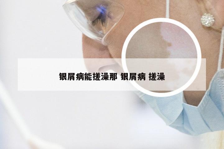 银屑病能搓澡那 银屑病 搓澡