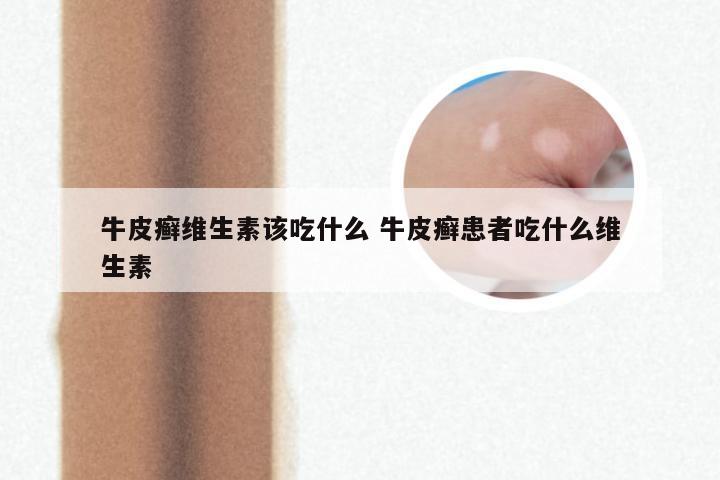 牛皮癣维生素该吃什么 牛皮癣患者吃什么维生素