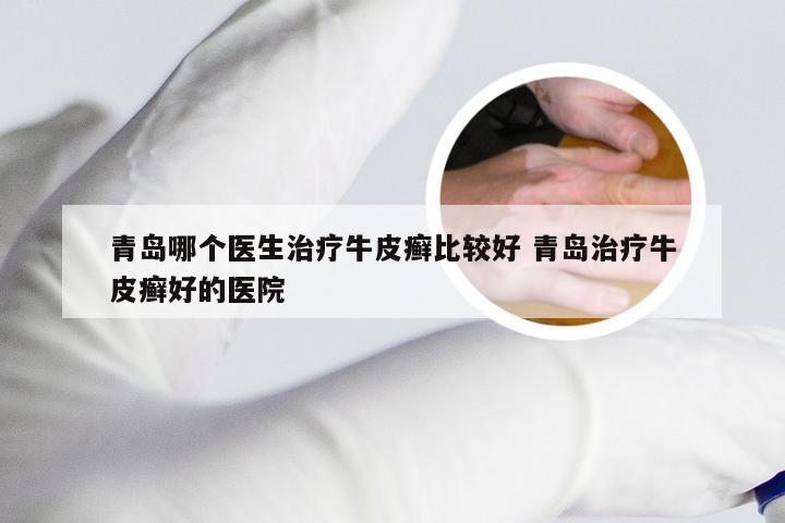 青岛哪个医生治疗牛皮癣比较好 青岛治疗牛皮癣好的医院