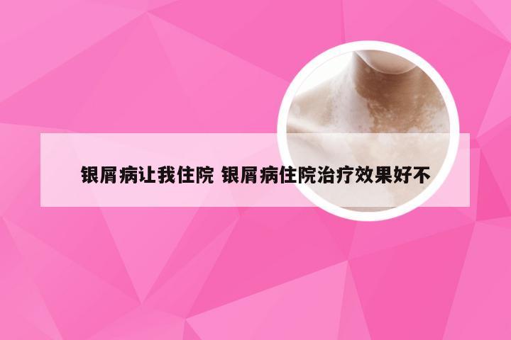 银屑病让我住院 银屑病住院治疗效果好不