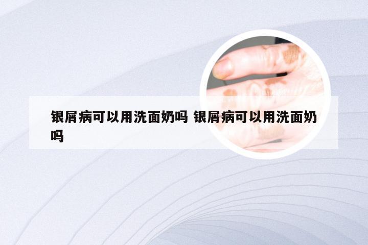 银屑病可以用洗面奶吗 银屑病可以用洗面奶吗