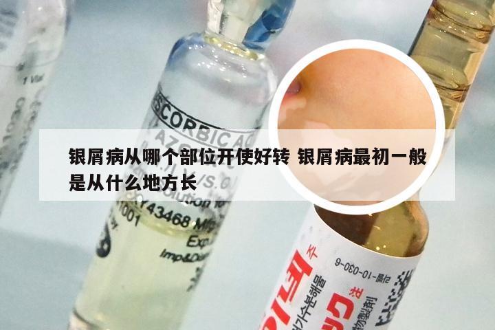 银屑病从哪个部位开使好转 银屑病最初一般是从什么地方长