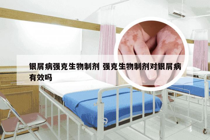银屑病强克生物制剂 强克生物制剂对银屑病有效吗