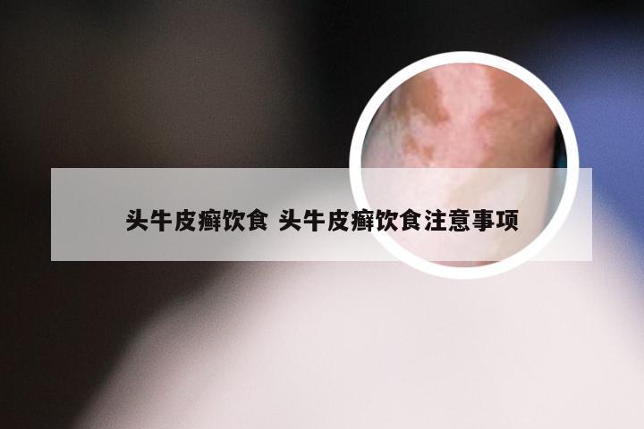 头牛皮癣饮食 头牛皮癣饮食注意事项