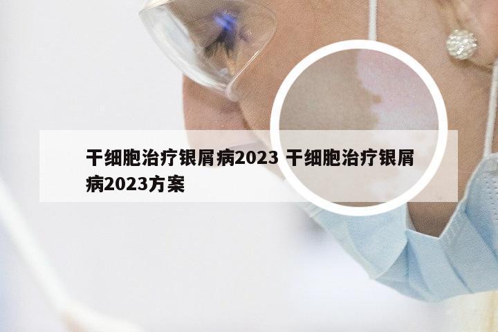 干细胞治疗银屑病2023 干细胞治疗银屑病2023方案