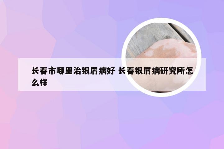 长春市哪里治银屑病好 长春银屑病研究所怎么样