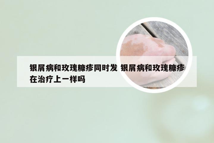 银屑病和玫瑰糠疹同时发 银屑病和玫瑰糠疹在治疗上一样吗