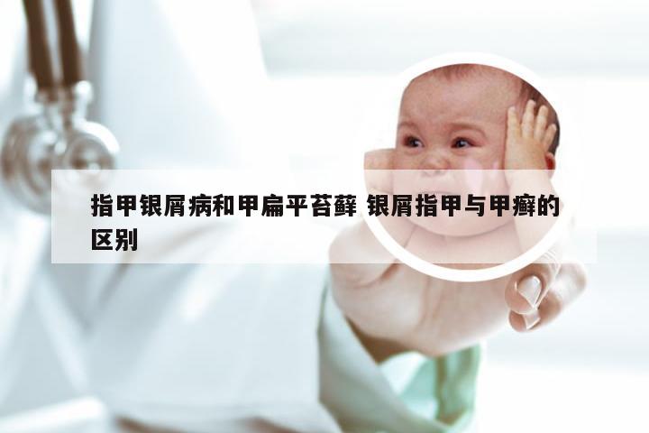 指甲银屑病和甲扁平苔藓 银屑指甲与甲癣的区别