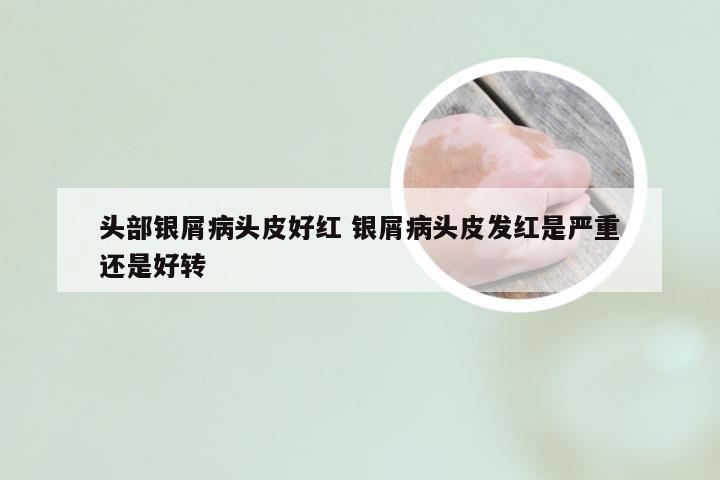 头部银屑病头皮好红 银屑病头皮发红是严重还是好转