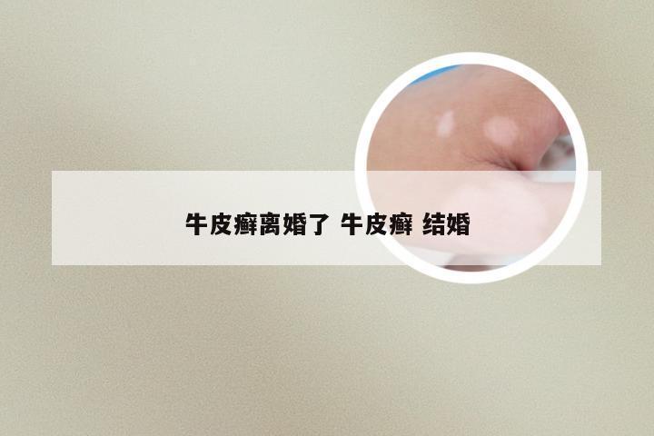 牛皮癣离婚了 牛皮癣 结婚