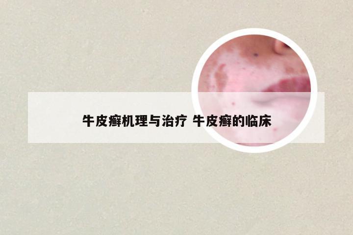 牛皮癣机理与治疗 牛皮癣的临床