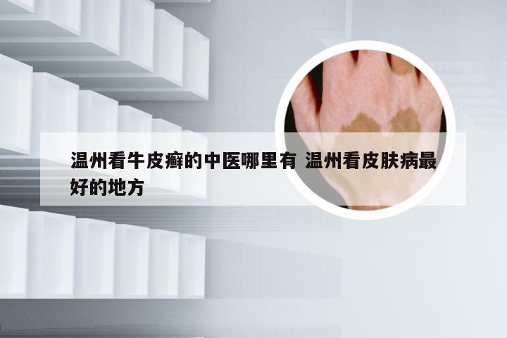 温州看牛皮癣的中医哪里有 温州看皮肤病最好的地方