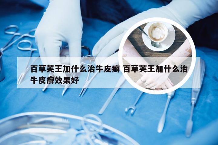 百草芙王加什么治牛皮癣 百草芙王加什么治牛皮癣效果好